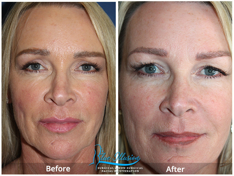 Multi Light Mask-Anti-aging LED Light Settings