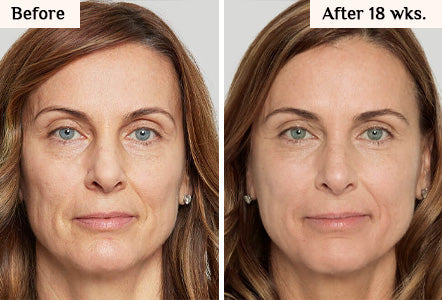 LED Laser for Youthful Skin
