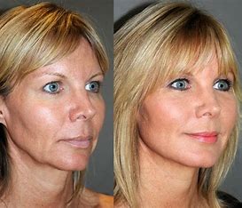 LED Laser for Youthful Skin