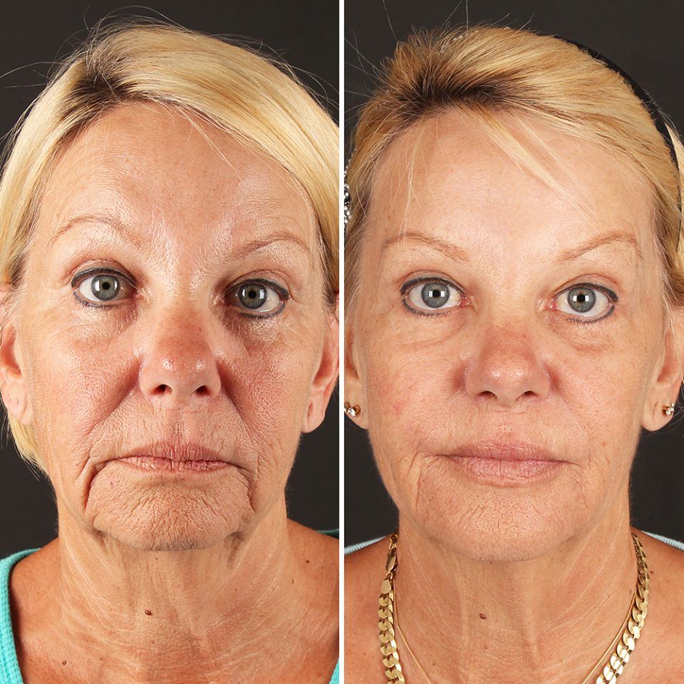 Multi Light Mask-Anti-aging LED Light Settings