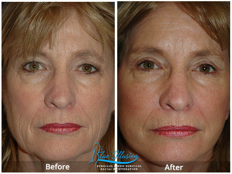 Women LED Laser Anti-aging