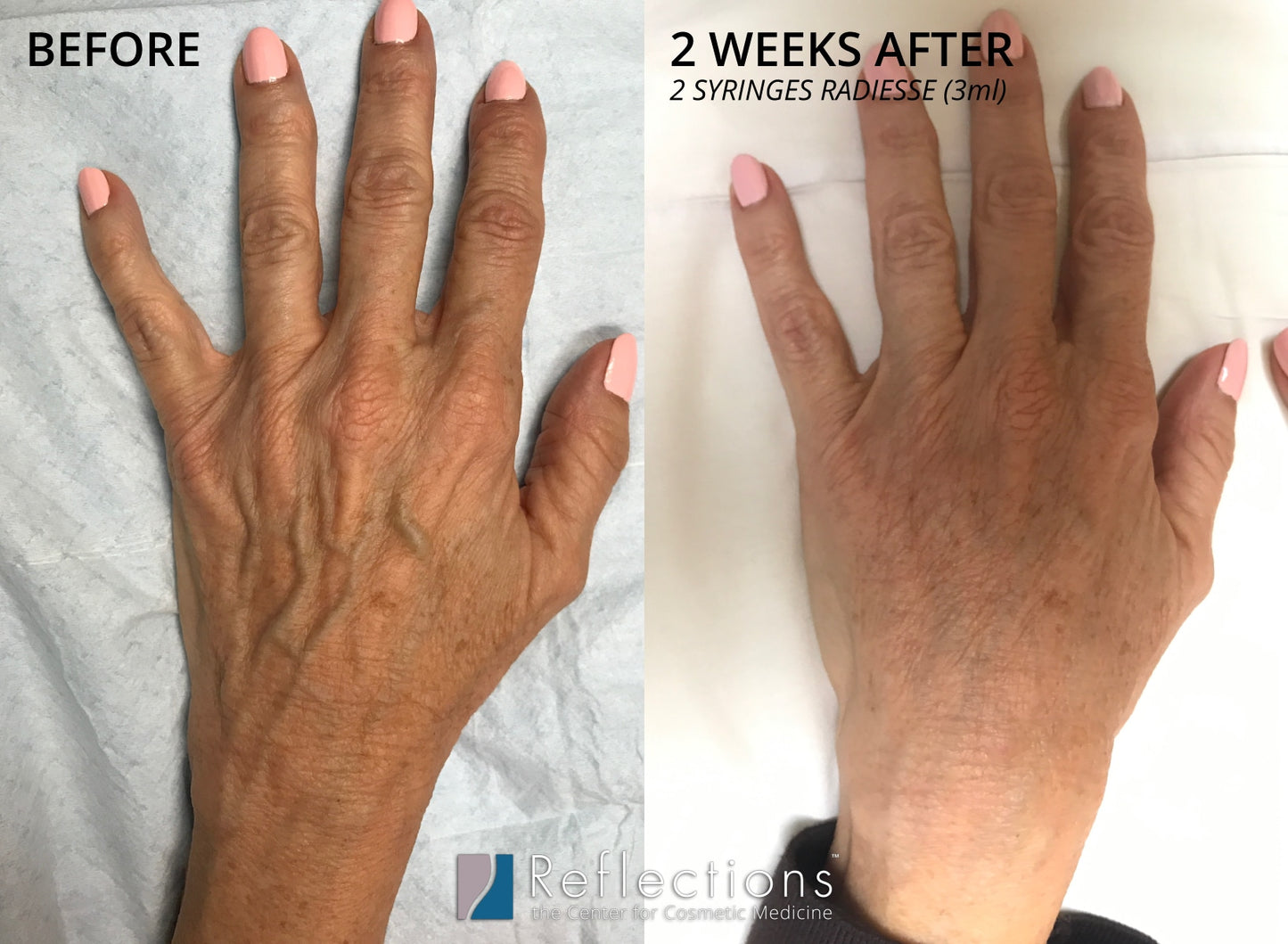 LED Laser for Youthful Skin
